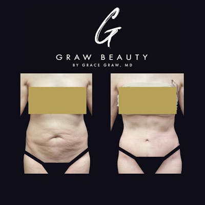Abdominoplasty Before & After Gallery - Patient 122446280 - Image 1