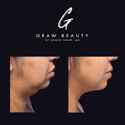 Facial Contouring / Submental Lipo Before & After Gallery - Patient 122446366 - Image 1