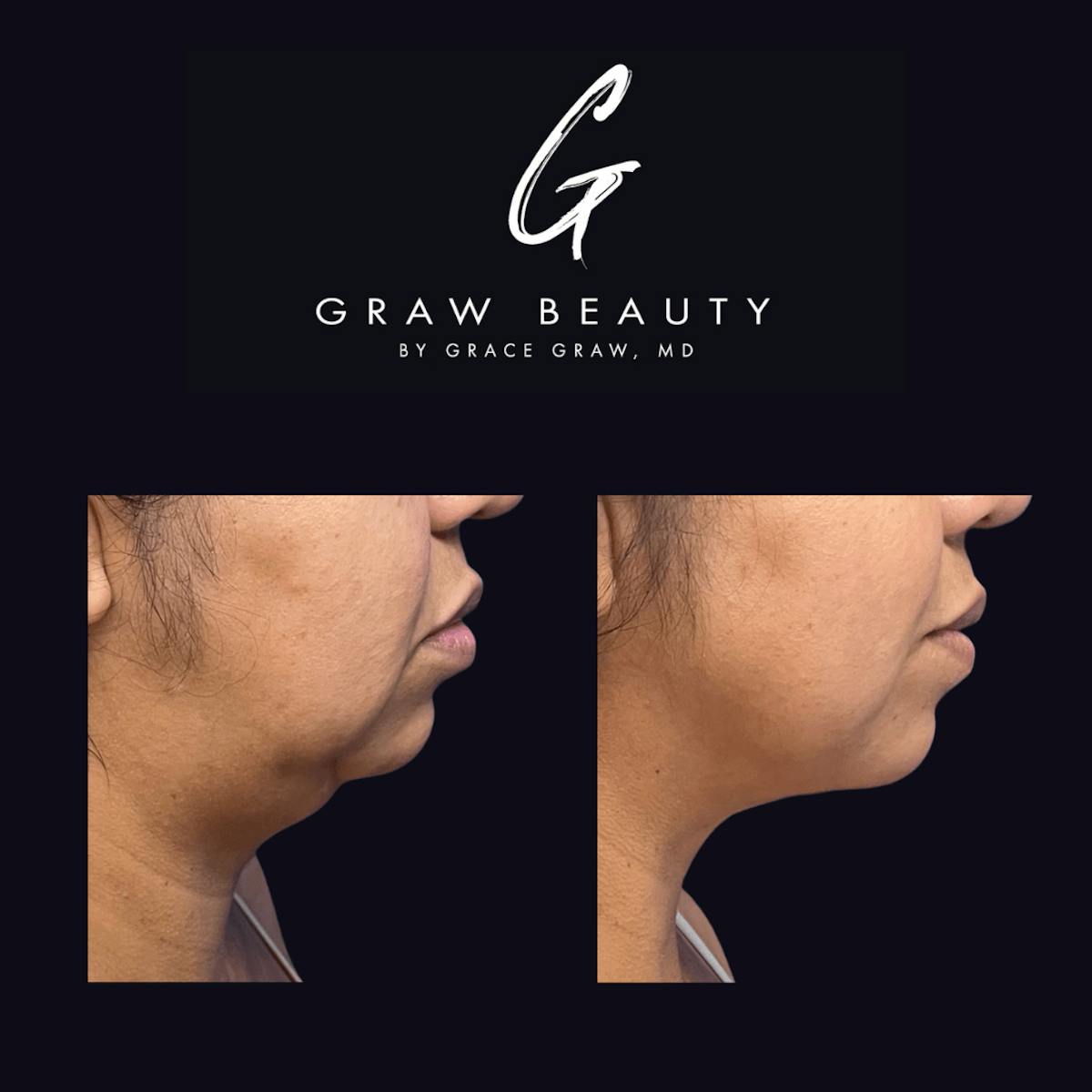 Facial Contouring / Submental Lipo Before & After Gallery - Patient 122446366 - Image 1