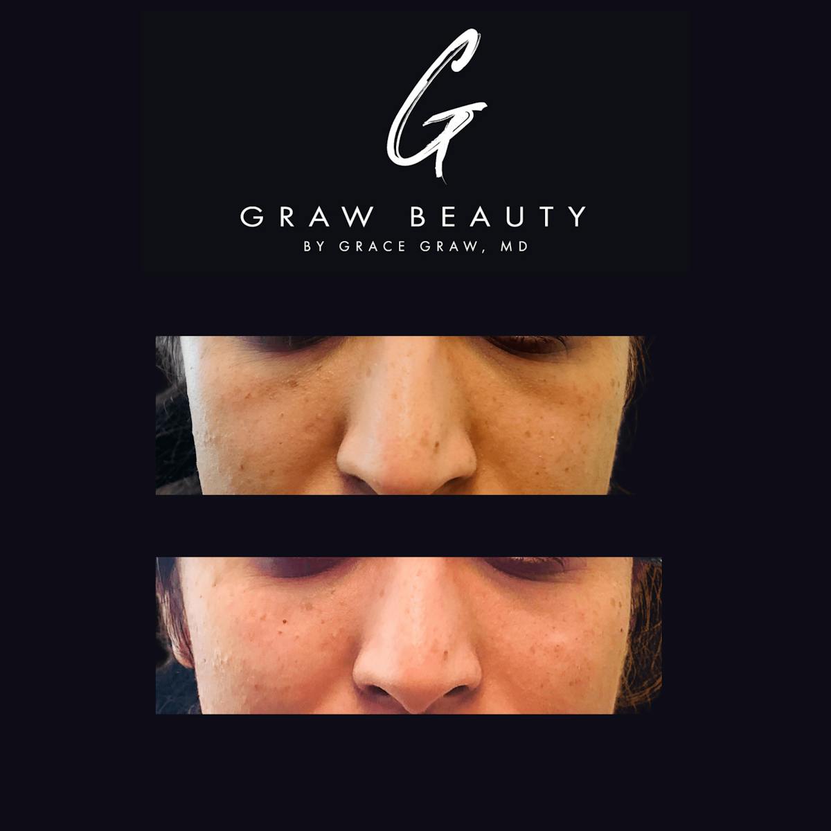 Dermal Filler Before & After Gallery - Patient 145245 - Image 1