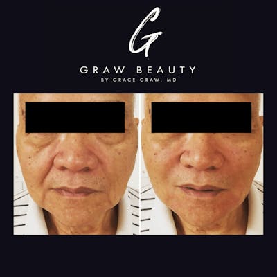 Dermal Filler Before & After Gallery - Patient 815982 - Image 1