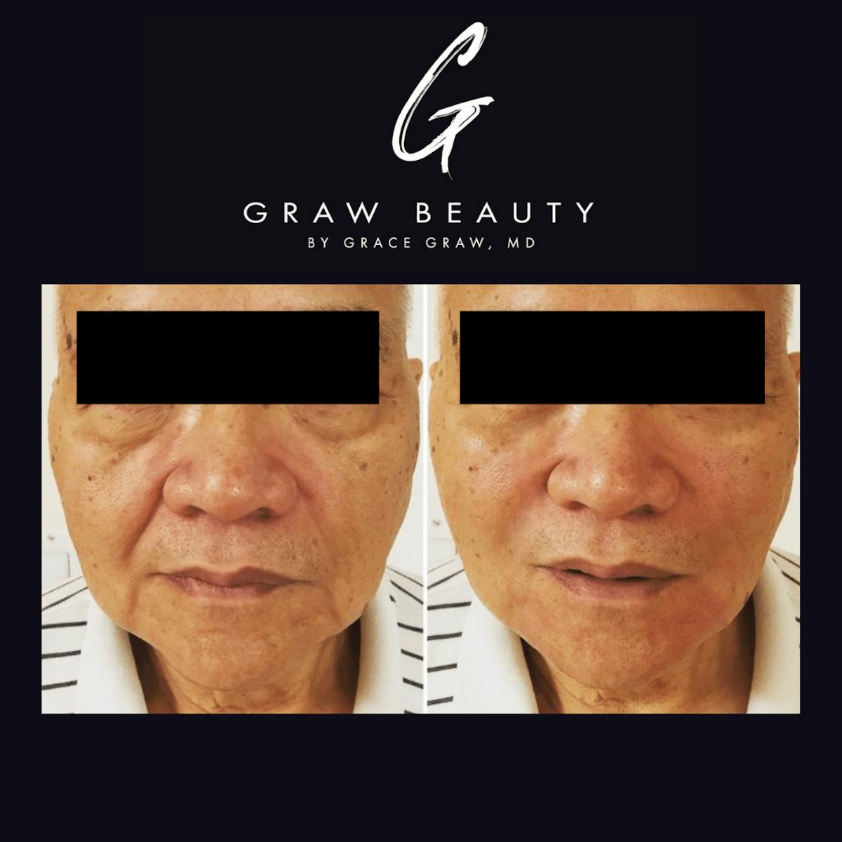 Dermal Filler Before & After Gallery - Patient 815982 - Image 1
