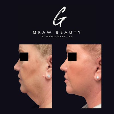 Facial Contouring / Submental Lipo Before & After Gallery - Patient 122446370 - Image 1