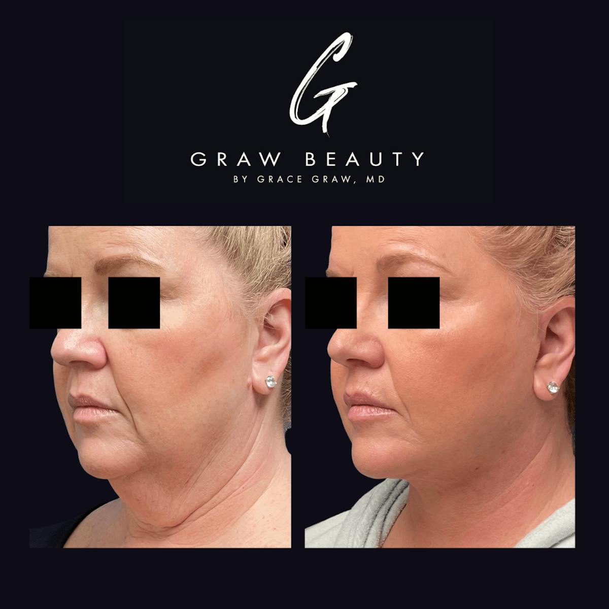 Facial Contouring / Submental Lipo Before & After Gallery - Patient 122446370 - Image 2