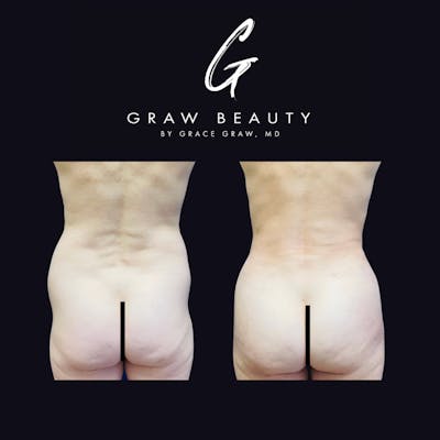 Liposuction + Fat Grafting Before & After Gallery - Patient 122446495 - Image 1