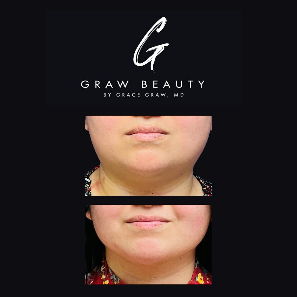 Facial Contouring / Submental Lipo Before & After Gallery - Patient 147739683 - Image 1