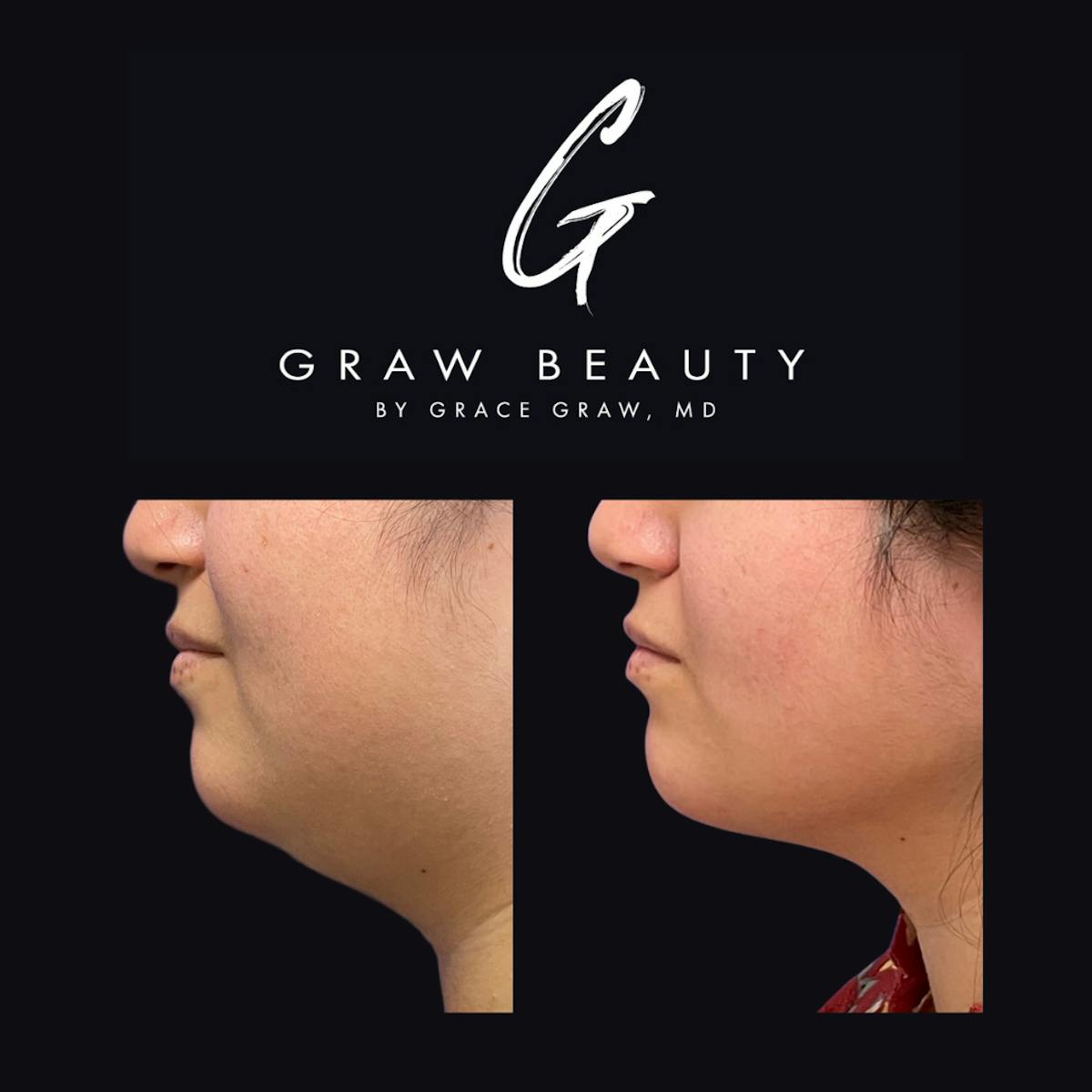 Facial Contouring / Submental Lipo Before & After Gallery - Patient 147739683 - Image 3