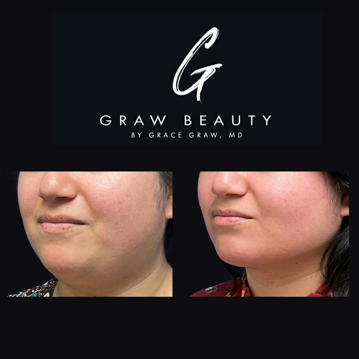 Facial Contouring / Submental Lipo Before & After Gallery - Patient 147739683 - Image 2
