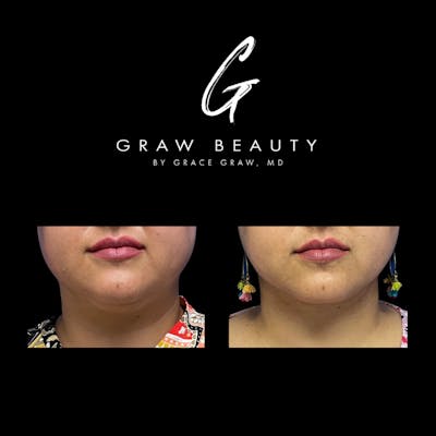 Facial Contouring / Submental Lipo Before & After Gallery - Patient 147739686 - Image 1