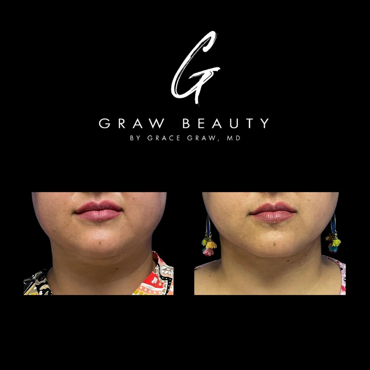 Facial Contouring / Submental Lipo Before & After Gallery - Patient 147739686 - Image 1