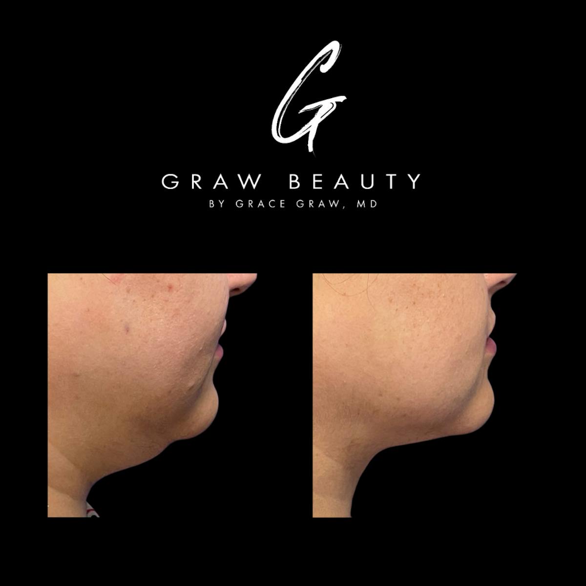 Facial Contouring / Submental Lipo Before & After Gallery - Patient 147739686 - Image 3