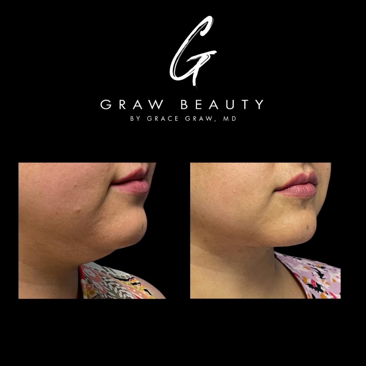 Facial Contouring / Submental Lipo Before & After Gallery - Patient 147739686 - Image 2