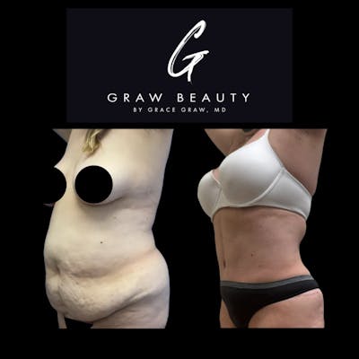 Liposuction Before & After Gallery - Patient 859845 - Image 1