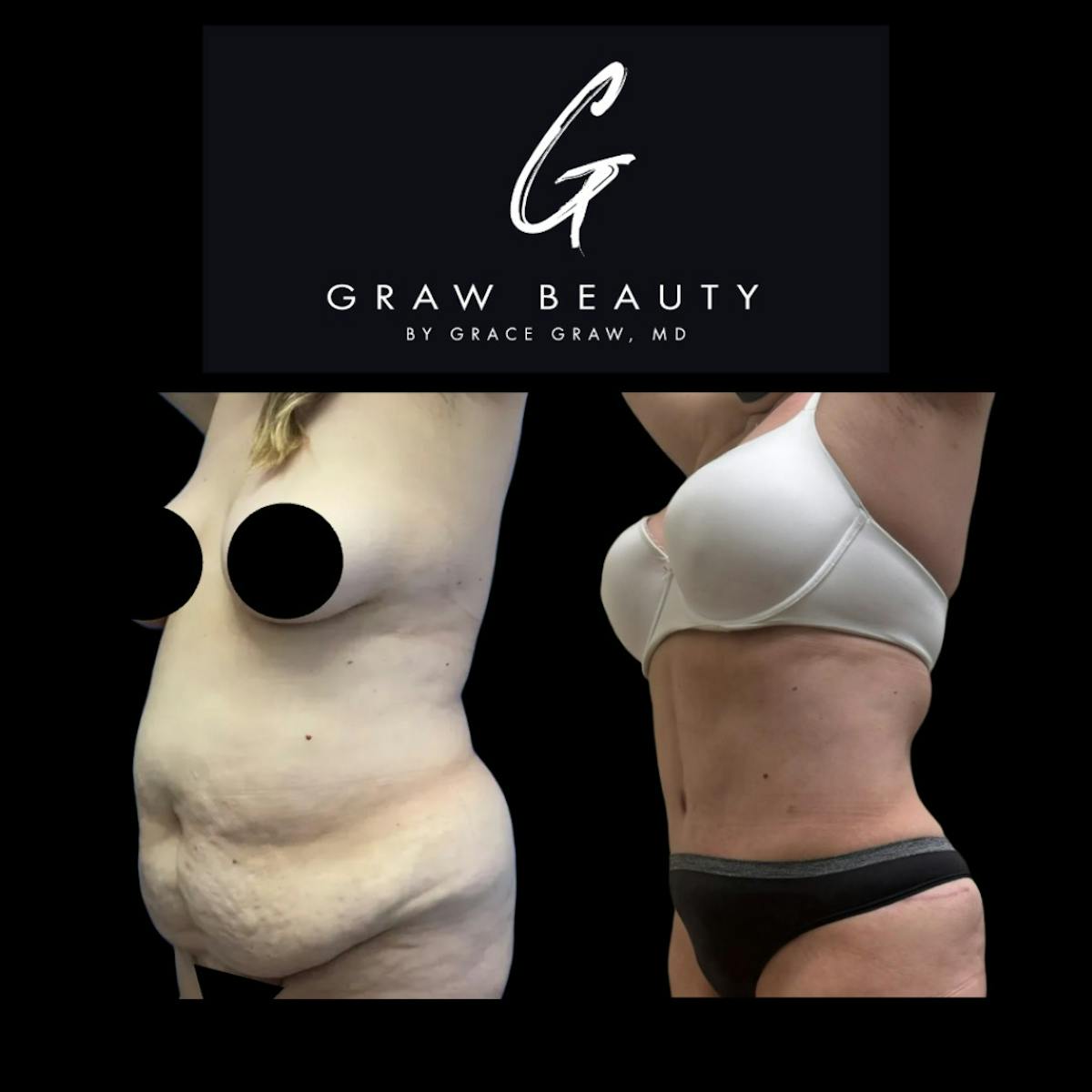 Liposuction Before & After Gallery - Patient 859845 - Image 1
