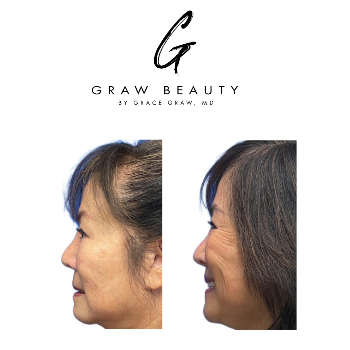 Lip Lift  Before & After Gallery - Patient 238330 - Image 2