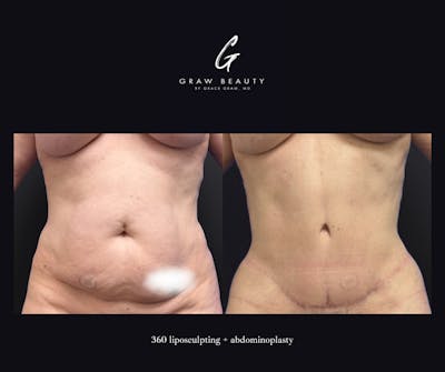Liposuction Before & After Gallery - Patient 263935 - Image 1