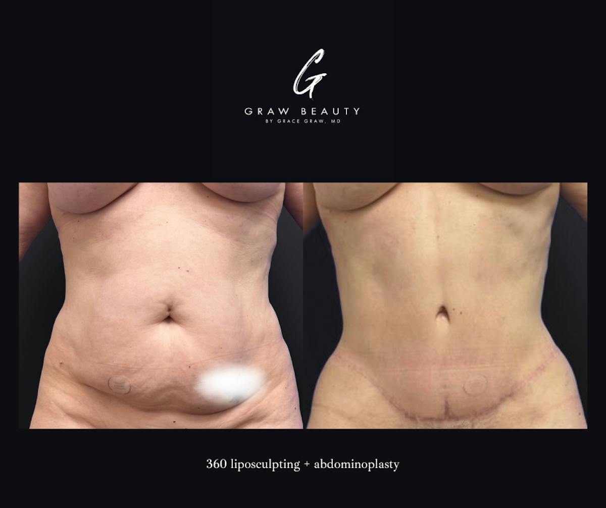 Liposuction Before & After Gallery - Patient 263935 - Image 1
