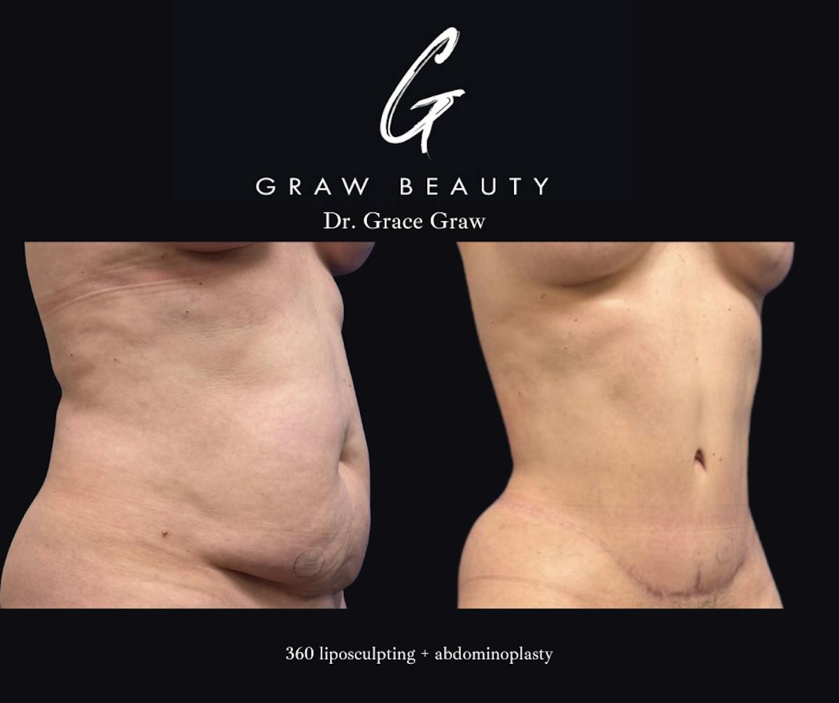 Liposuction Before & After Gallery - Patient 263935 - Image 2