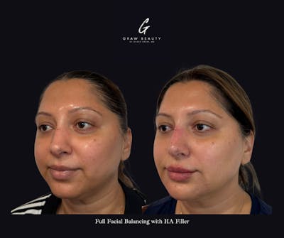 Dermal Filler Before & After Gallery - Patient 374931 - Image 1