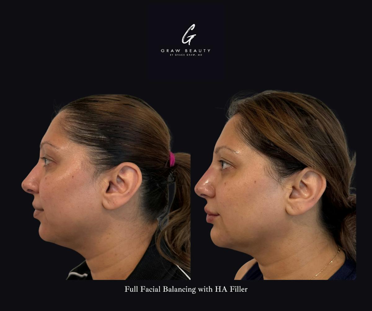 Dermal Filler Before & After Gallery - Patient 374931 - Image 2