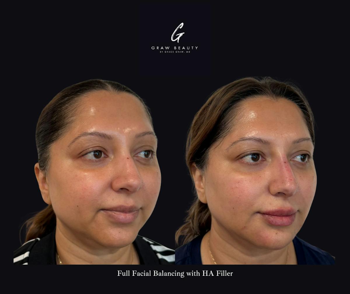 Dermal Filler Before & After Gallery - Patient 374931 - Image 3