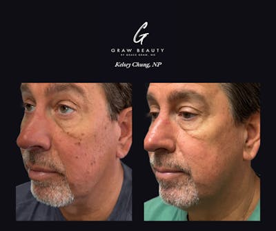 Dermal Filler Before & After Gallery - Patient 629875 - Image 1