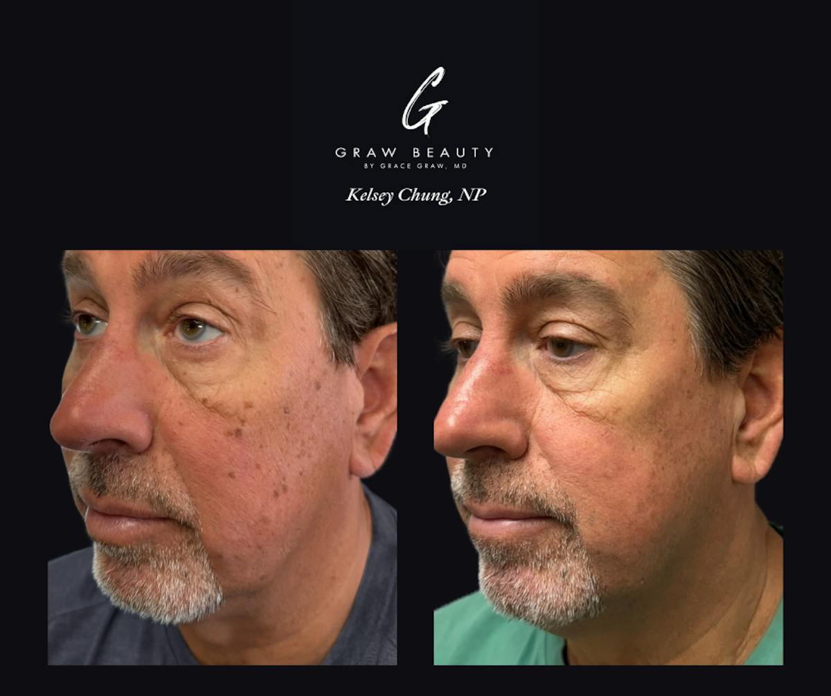 Dermal Filler Before & After Gallery - Patient 629875 - Image 1