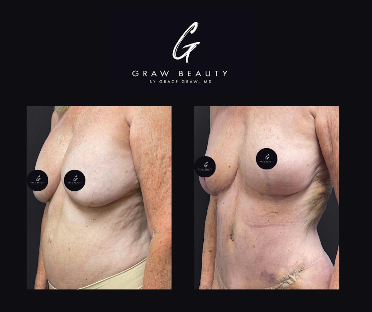 Breast Lift Before & After Gallery - Patient 590799 - Image 1