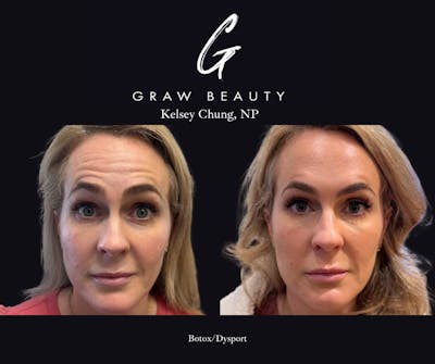 Botox/Dysport Before & After Gallery - Patient 259737 - Image 1
