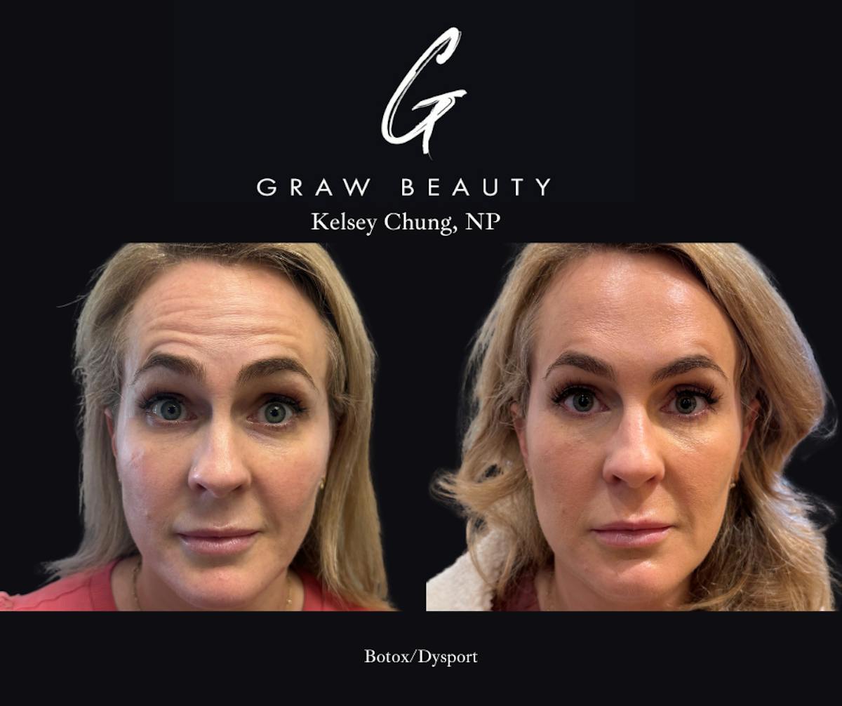 Botox/Dysport Before & After Gallery - Patient 259737 - Image 1