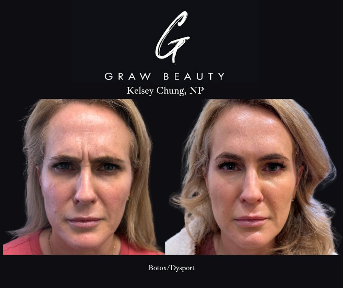 Botox/Dysport Before & After Gallery - Patient 259737 - Image 2