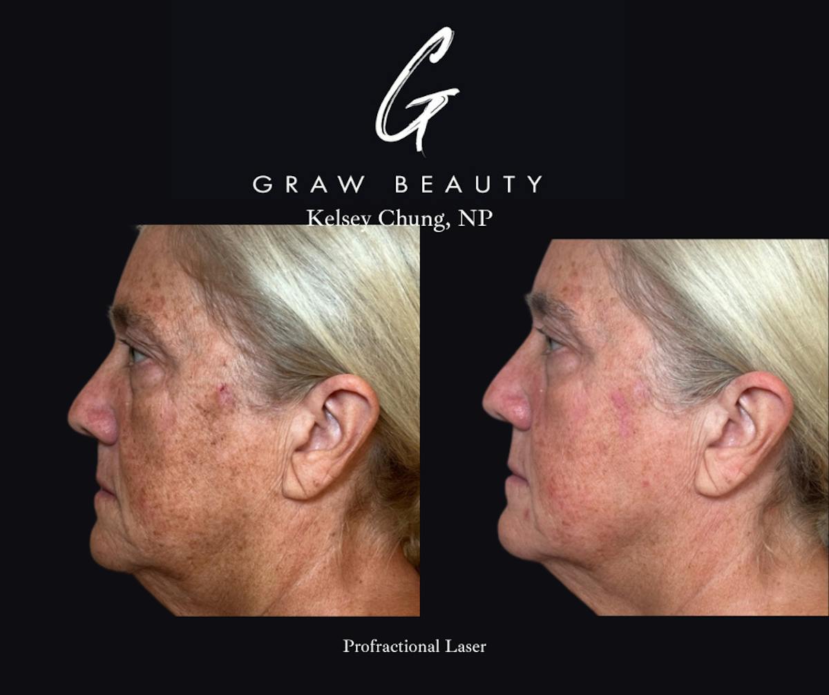 Laser Skin Resurfacing Before & After Gallery - Patient 314024 - Image 3