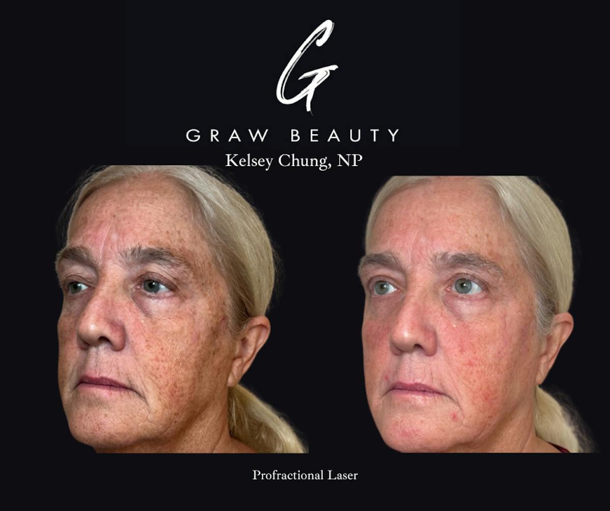 Laser Skin Resurfacing Before & After Gallery - Patient 314024 - Image 2
