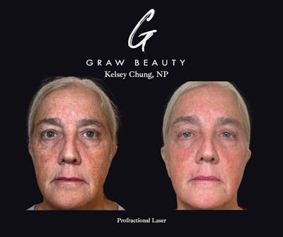 Laser Skin Resurfacing Before & After Gallery - Patient 314024 - Image 1