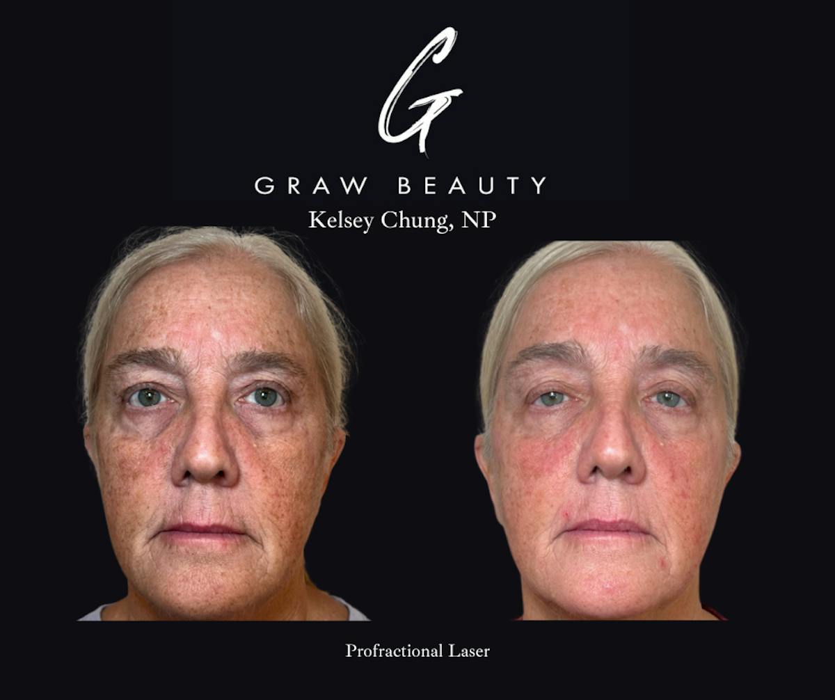 Laser Skin Resurfacing Before & After Gallery - Patient 314024 - Image 1