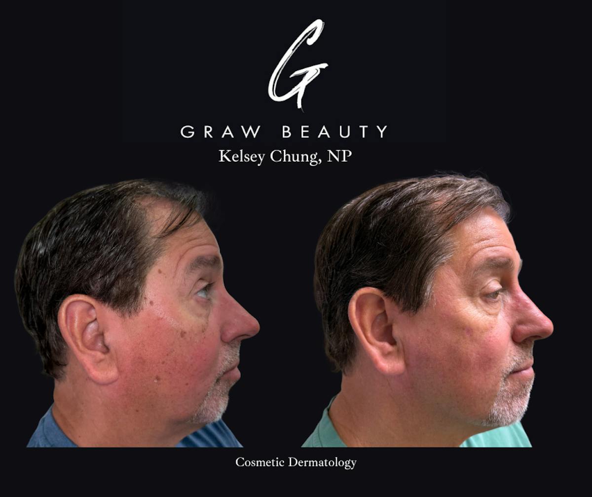 Cosmetic Dermatology Before & After Gallery - Patient 383957 - Image 2