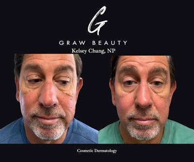 Cosmetic Dermatology Before & After Gallery - Patient 383957 - Image 1