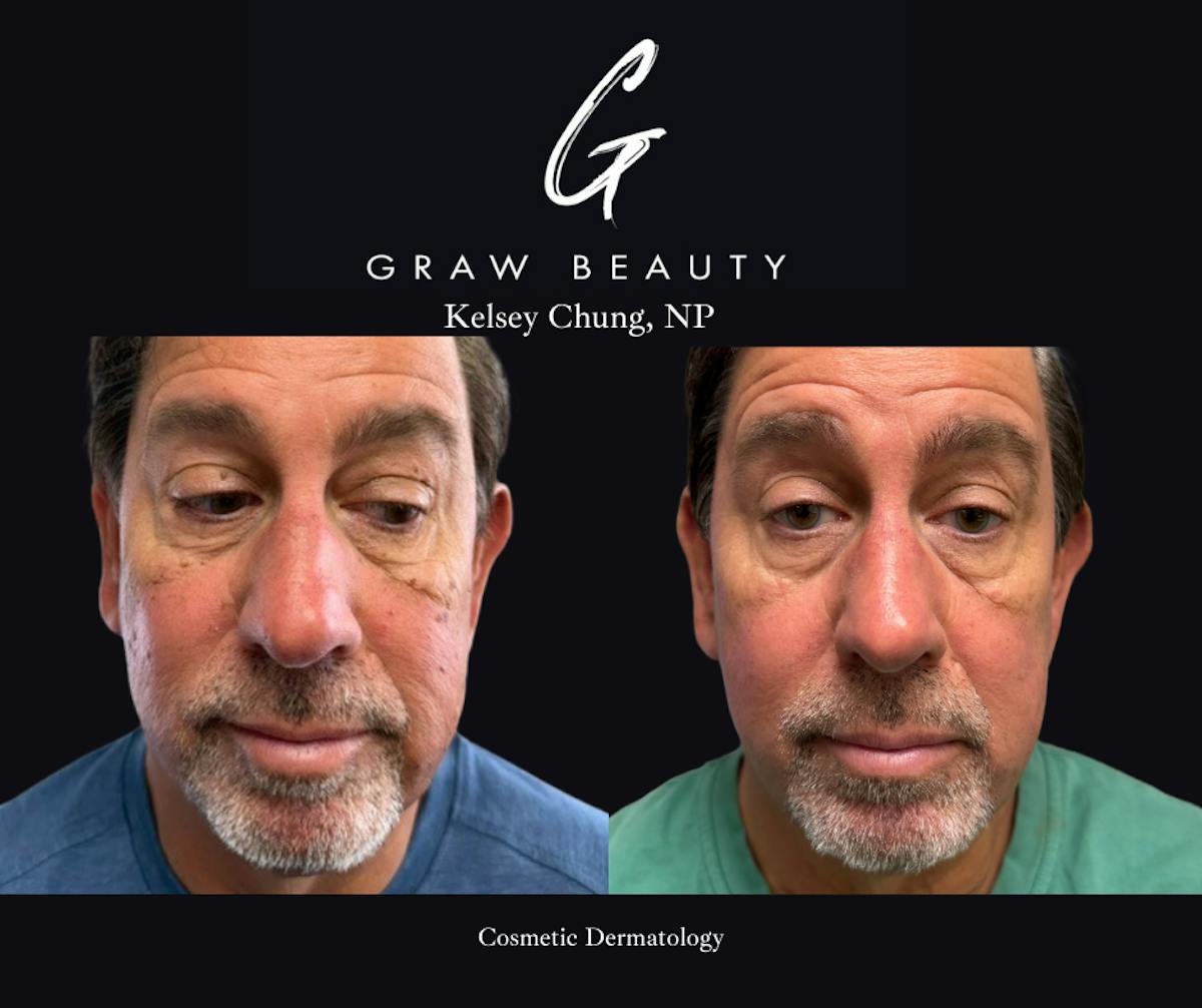 Cosmetic Dermatology Before & After Gallery - Patient 383957 - Image 1