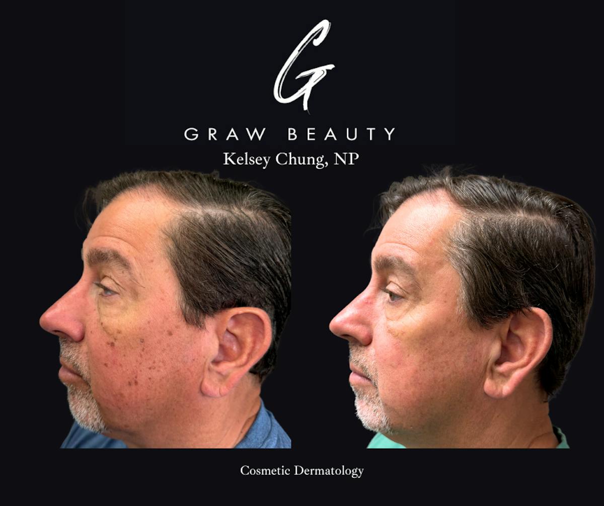 Cosmetic Dermatology Before & After Gallery - Patient 383957 - Image 3
