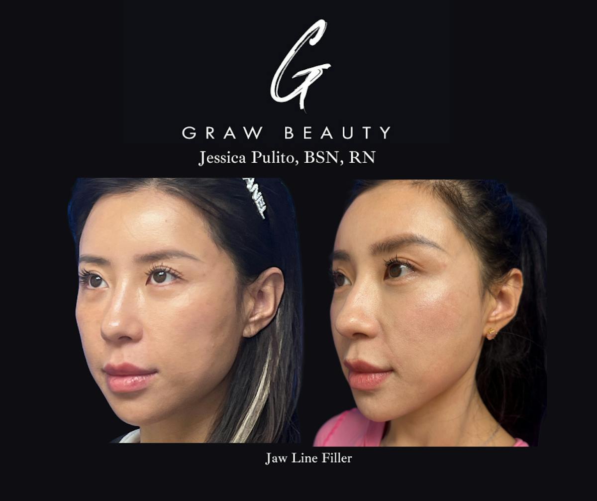 Dermal Filler Before & After Gallery - Patient 276375 - Image 3