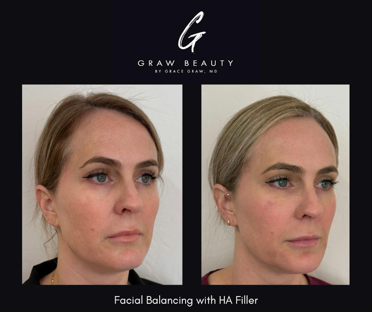 Dermal Filler Before & After Gallery - Patient 192488 - Image 2