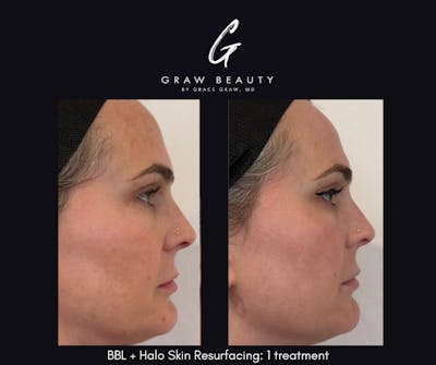 Laser Skin Resurfacing Before & After Gallery - Patient 912912 - Image 1