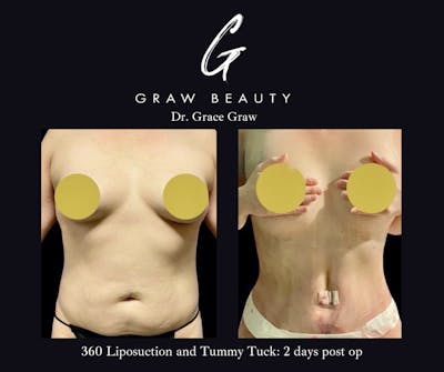 Liposuction Before & After Gallery - Patient 404473 - Image 1