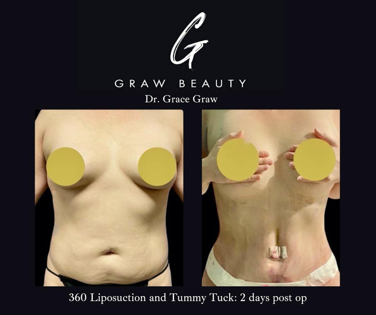 Liposuction Before & After Gallery - Patient 404473 - Image 1