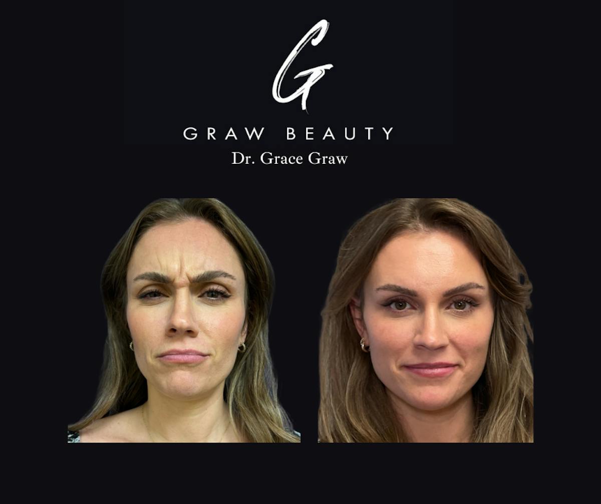 Botox/Dysport Before & After Gallery - Patient 132800 - Image 2