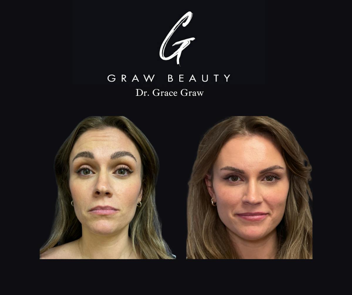 Botox/Dysport Before & After Gallery - Patient 132800 - Image 1