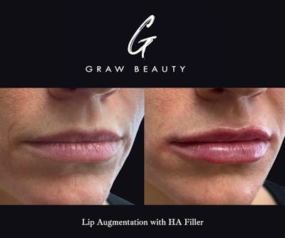 Dermal Filler Before & After Gallery - Patient 425481 - Image 1