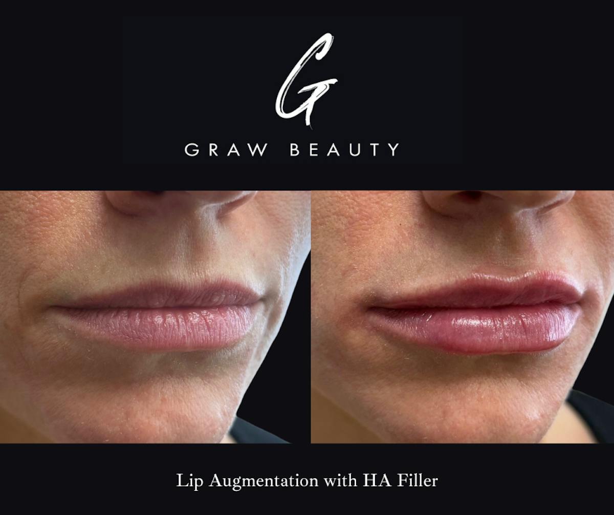 Dermal Filler Before & After Gallery - Patient 425481 - Image 1