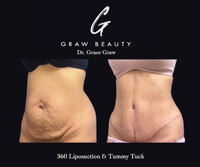 Liposuction Before & After Gallery - Patient 447203 - Image 1
