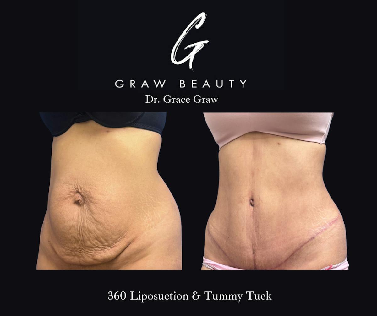 Abdominoplasty Before & After Gallery - Patient 296095 - Image 2